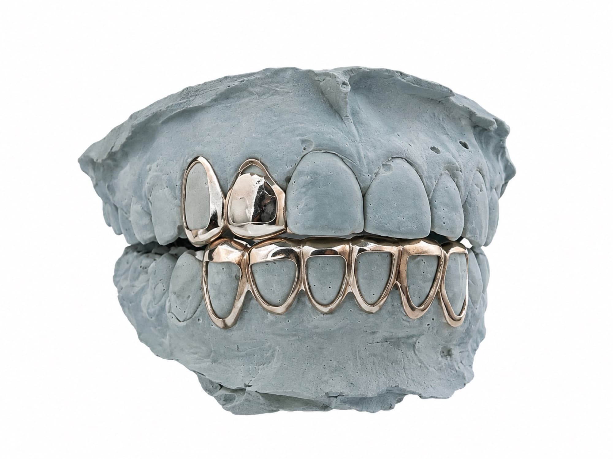 Open-face bottom set on a dental cast